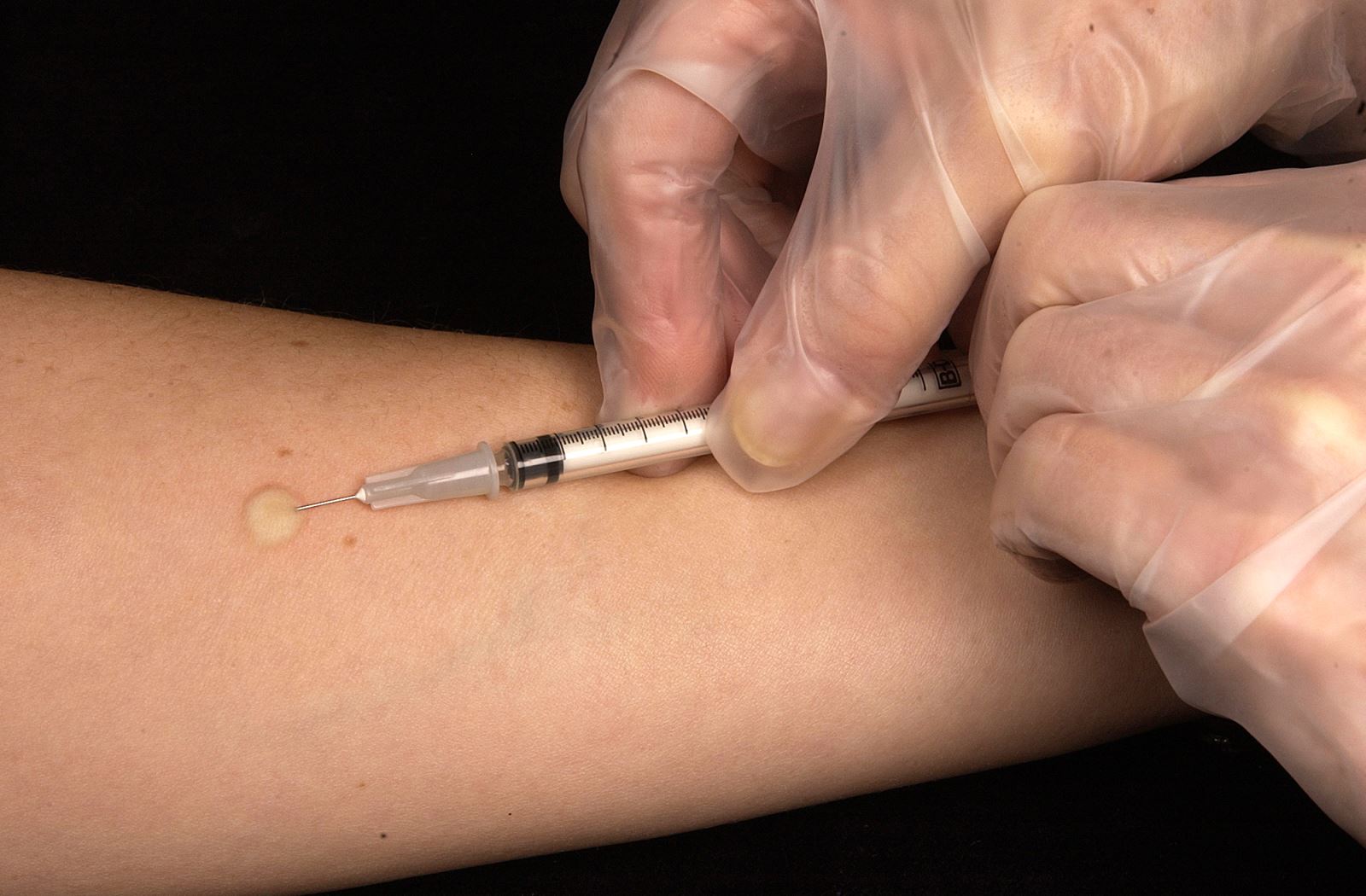 Phản ứng Mantoux (test nội bì, TST)
