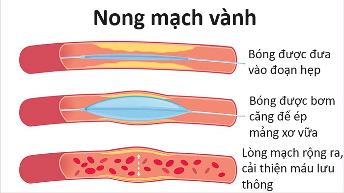 Nong mạch vành