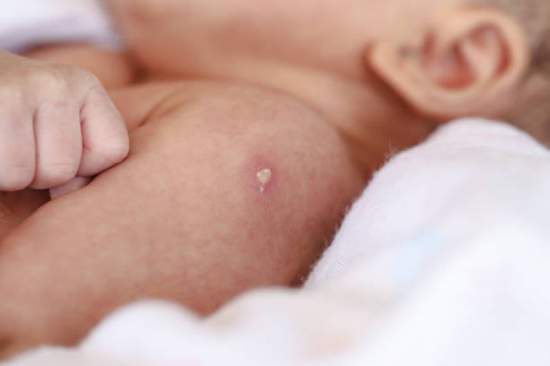 Phản ứng sau tiêm vaccine BCG ở trẻ sơ sinh