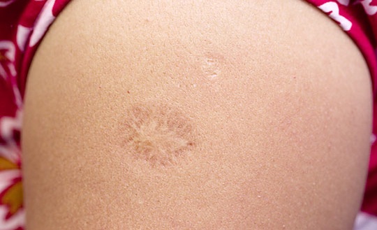 Sẹo sau tiêm vaccine ngừa lao BCG